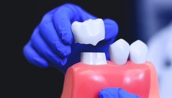 Dental Crowns 101: All You Need To Know 