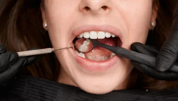 Why Consider Saving Your Natural Tooth Undergoing Root Canals?