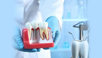 The Complete Guide to Dental Implants: What You Need to Know