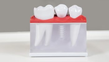 How Long Do Dental Implants Last? Expert Insights